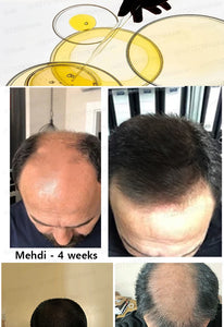 Fastest  Hair Regrowth